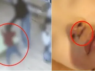 "I got hurt while playing" - Nursery teacher throws 4-year-old child, injury requires 6 stitches = South Korea