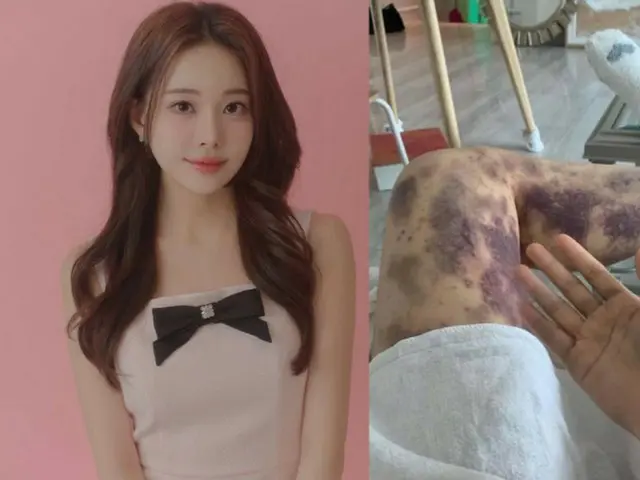 Popular YouTuber wins lawsuit over bruises all over body after injection at dermatologist in South Korea
